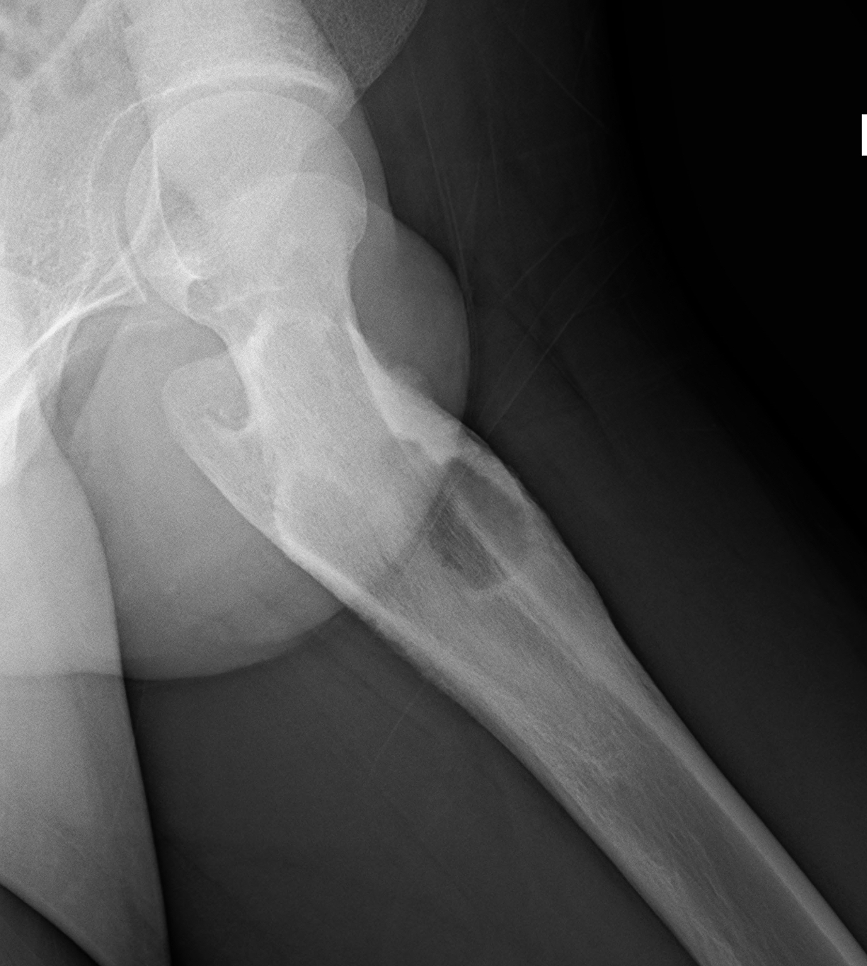 Osteoblastoma The Bone School